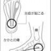 足の裏に痛み… 足底腱膜炎、足休めて衝撃波で治療も